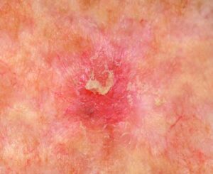 Chronisch lichtgeschädigte Haut bei Aktinischen Keratosen