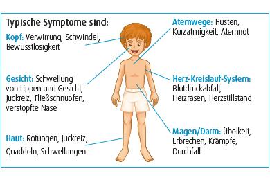 Symptome einer Anaphylaxie