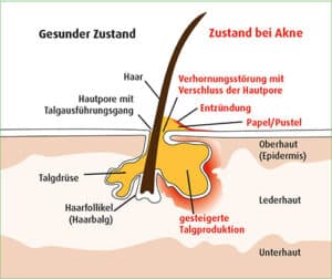 Entstehung der Akne