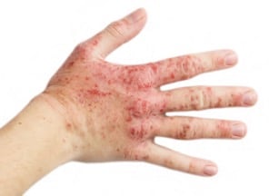 Handekzem Handdermatitis