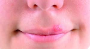 Lippenherpes schmerzende Bläschen