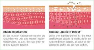 Neurodermitis Intakte Hautbarriere Barriere defekt