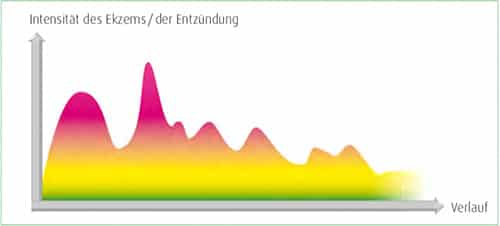 Neurodermitis Verlauf Ekzem Entzündung