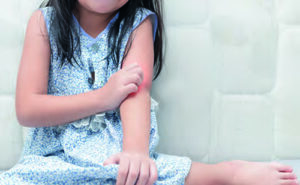 Psoriasis Schuppenflechte bei Kindern