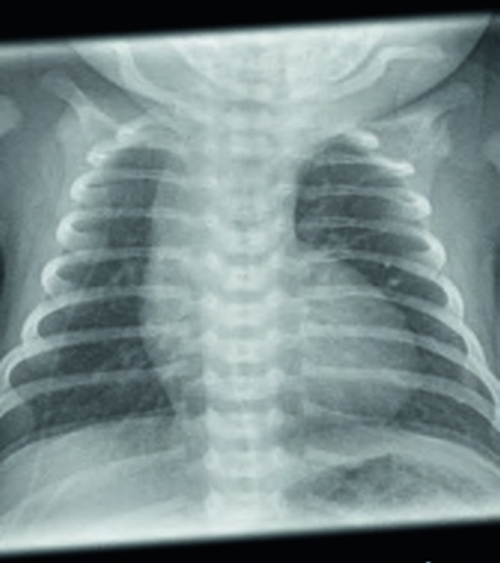 Röntgenbild Frühgeborene