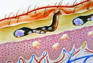 Krätze/Scabies • InfectoPharm ○ Wissen wirkt.