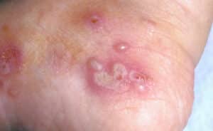 Typisches Krankheitsbild Krätze Scabies