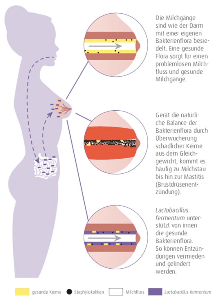 Schmerzen beim Stillen Grafik Milchstau