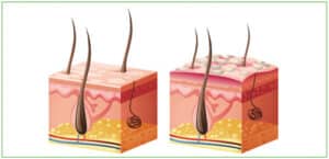 Psoriasis Schuppenflechte dicke schuppige obere Hautschicht