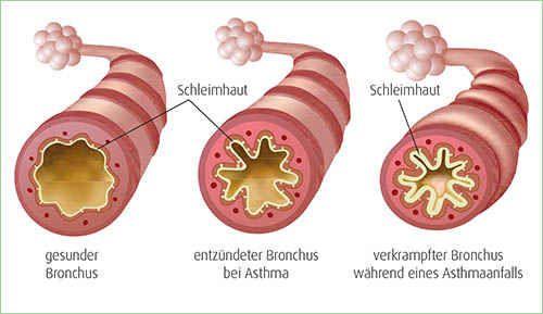 Veränderungen des Bronchus bei Asthma